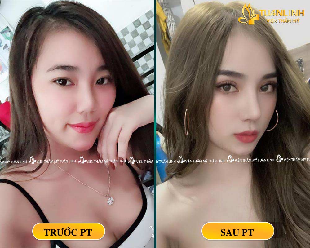 Hình ảnh khách hàng sau khi NÂNG MŨI SIÊU CẤU TRÚC