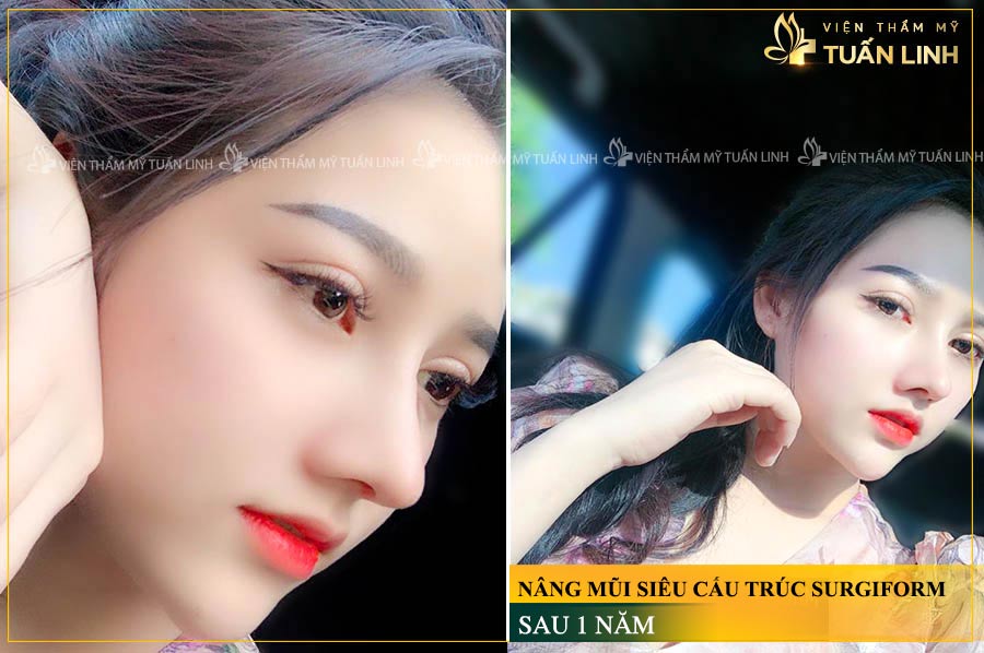 Hình ảnh khách hàng sau khi NÂNG MŨI SIÊU CẤU TRÚC
