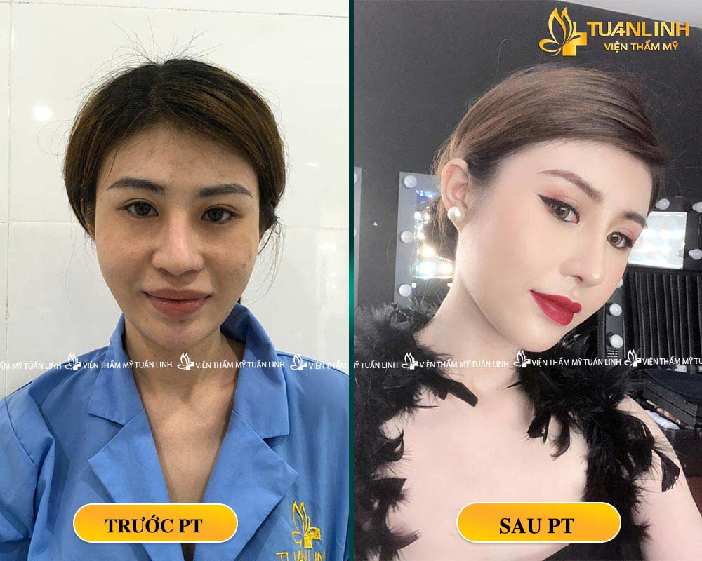 Khách hàng sửa mũi tại VTM Tuấn Linh