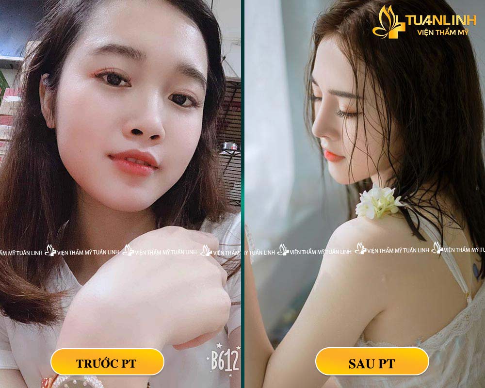 Khách hàng nâng mũi tại Tuấn Linh