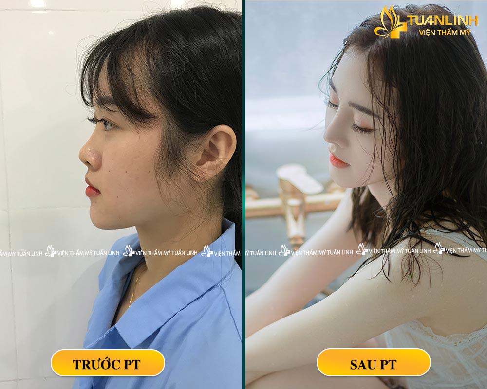 Khách hàng sửa mũi tại VTM Tuấn Linh
