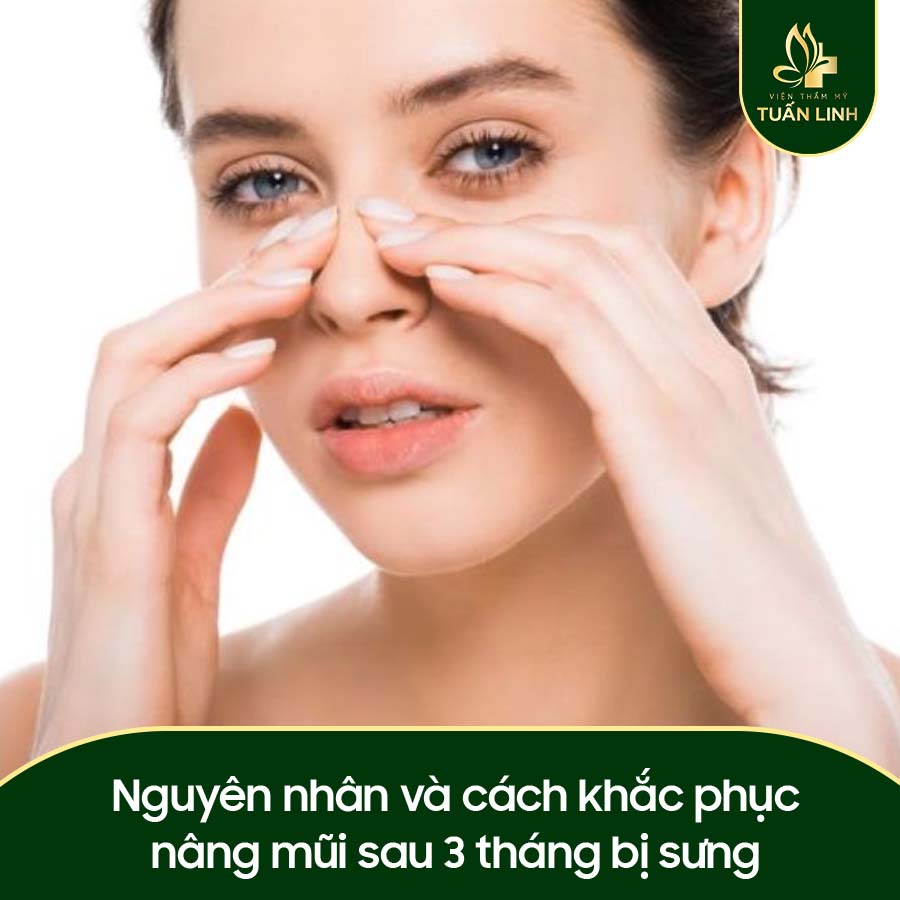 Nguyên nhân và cách khắc phục nâng mũi sau 3 tháng bị sưng