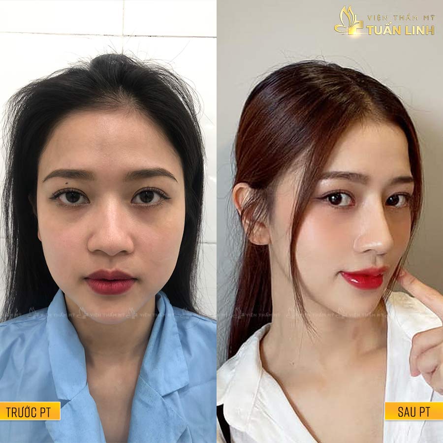 ThanhXuan - Hình ảnh khách hàng nâng mũi trả góp cùng Tuấn Linh