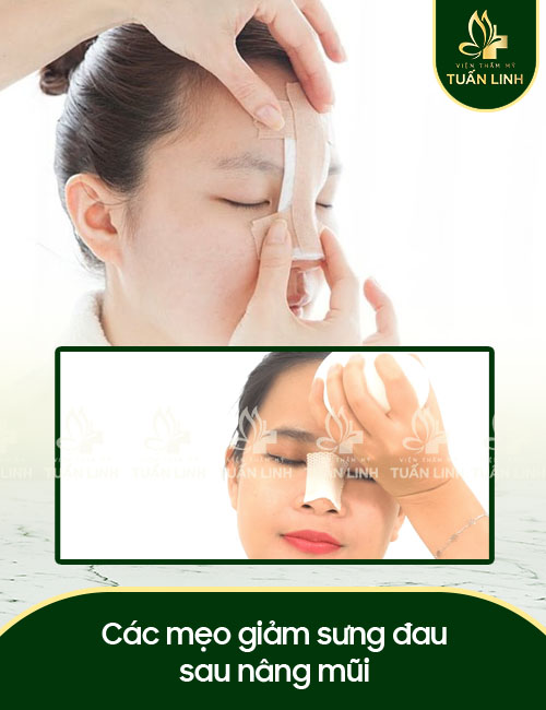 Các mẹo giảm sưng đau sau nâng mũi