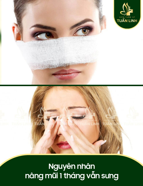 Nguyên nhân nâng mũi 1 tháng vẫn sưng