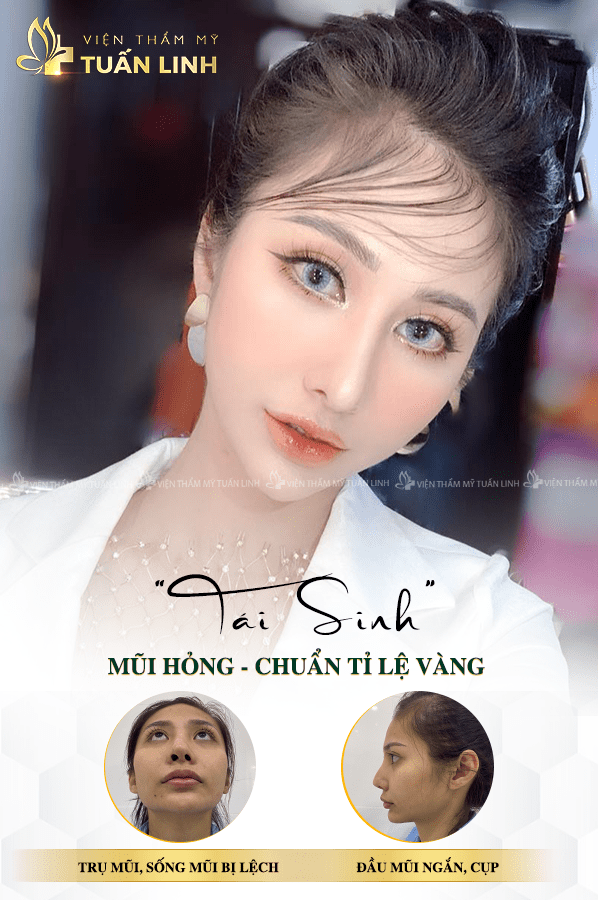 Khách hàng mũi bị lệch sau khi sửa lại mũi