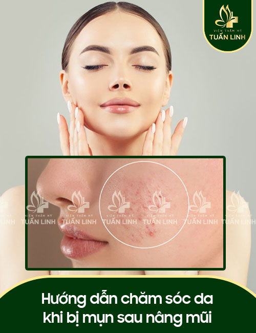 Hướng dẫn chăm sóc da khi bị mụn sau nâng mũi