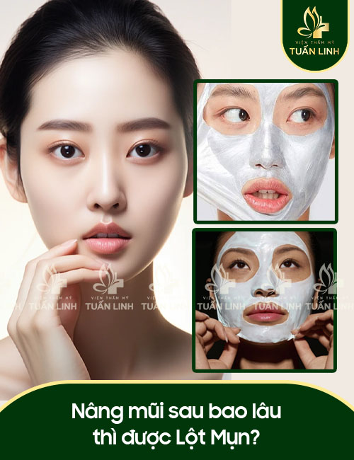 Nâng mũi sau bao lâu thì được Lột Mụn?