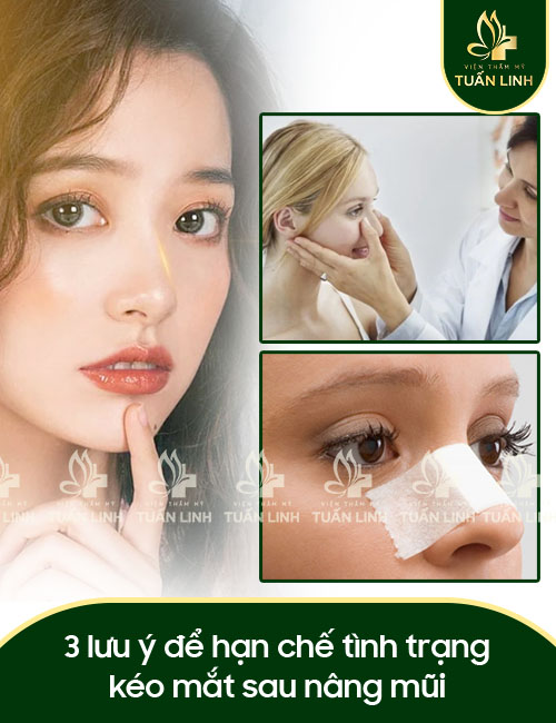 3 lưu ý để hạn chế tình trạng kéo mắt sau nâng mũi