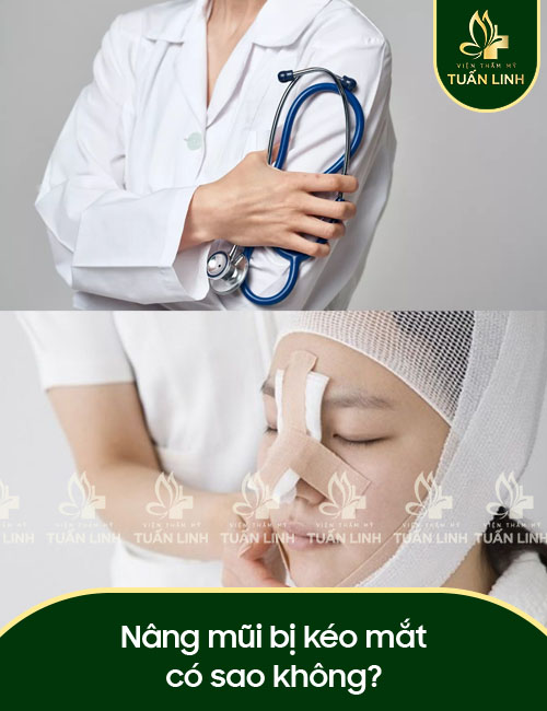 Bác sĩ giải đáp: Nâng mũi bị kéo mắt có sao không?