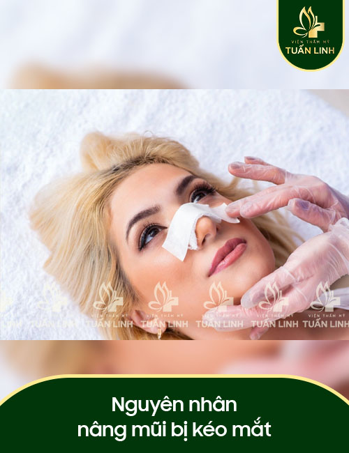 Nguyên nhân nâng mũi bị kéo mắt