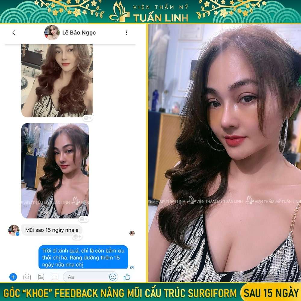 feedback của khách hàng nâng mũi cấu trúc surgiform