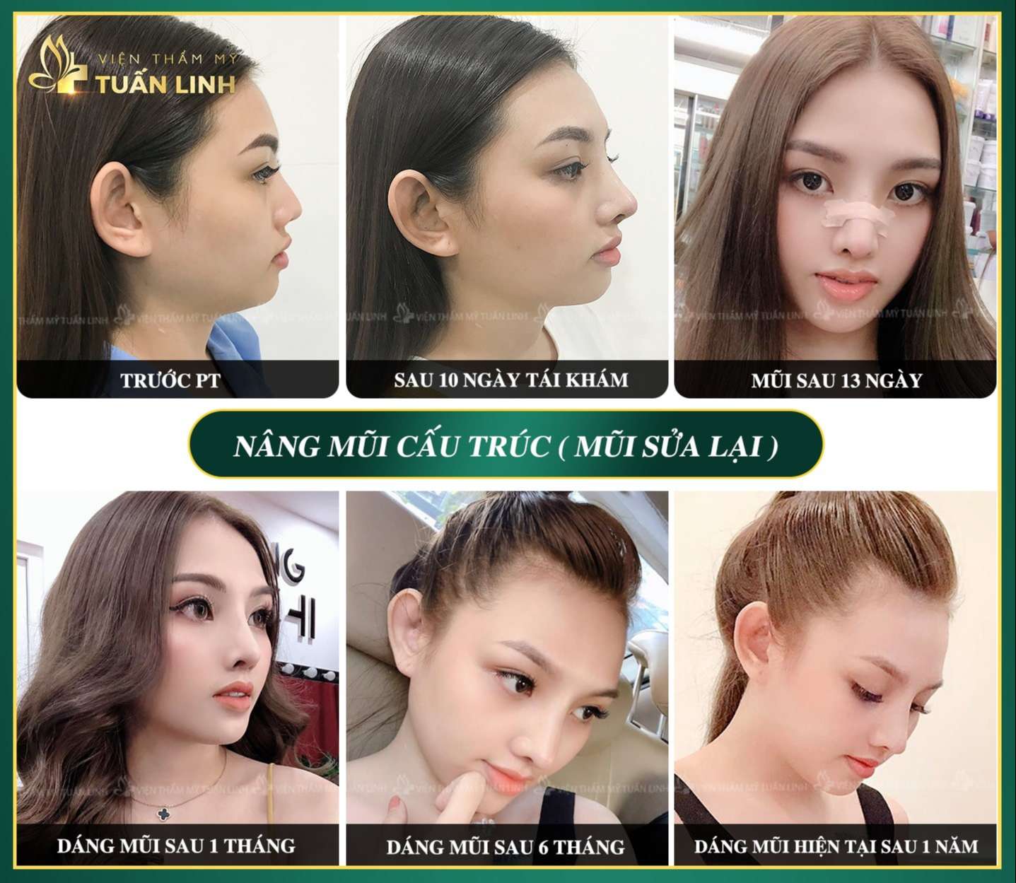 Quá trình nâng mũi của khách hàng