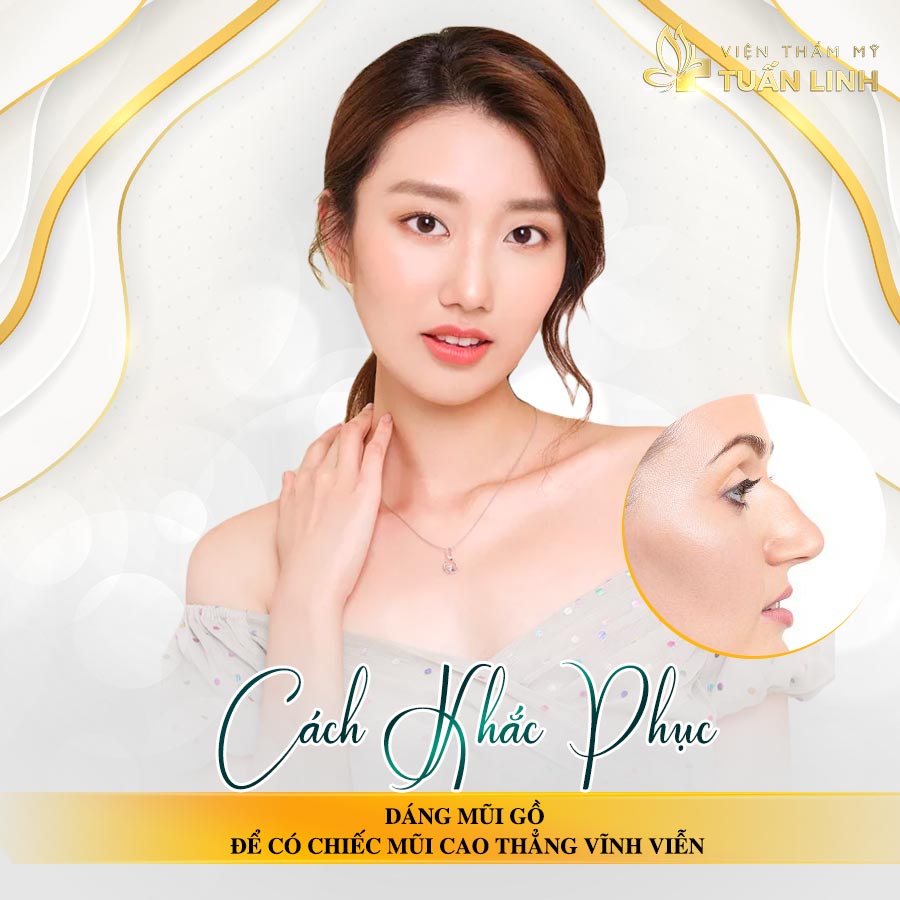 Cách khắc phục dáng mũi gồ để có chiếc mũi cao thẳng vĩnh viễn | Cách khắc phục dáng mũi gồ để có chiếc mũi cao thẳng vĩnh viễn