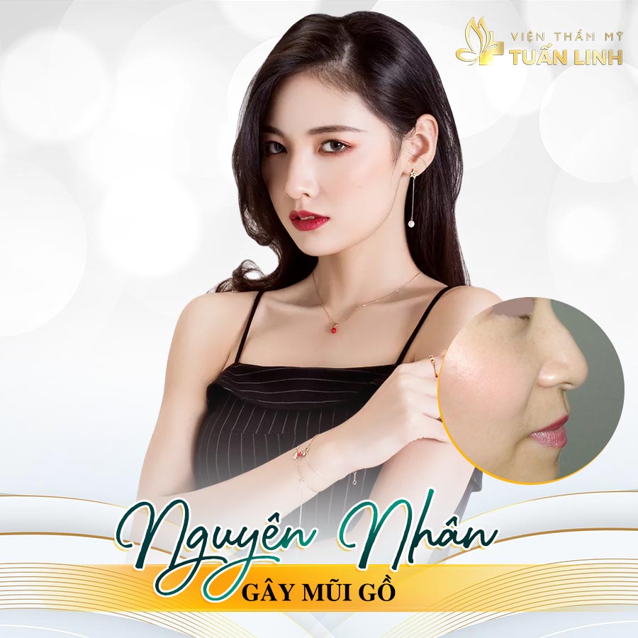 Nguyên nhân gây ra tình trạng mũi gồ | Cách khắc phục dáng mũi gồ để có chiếc mũi cao thẳng vĩnh viễn