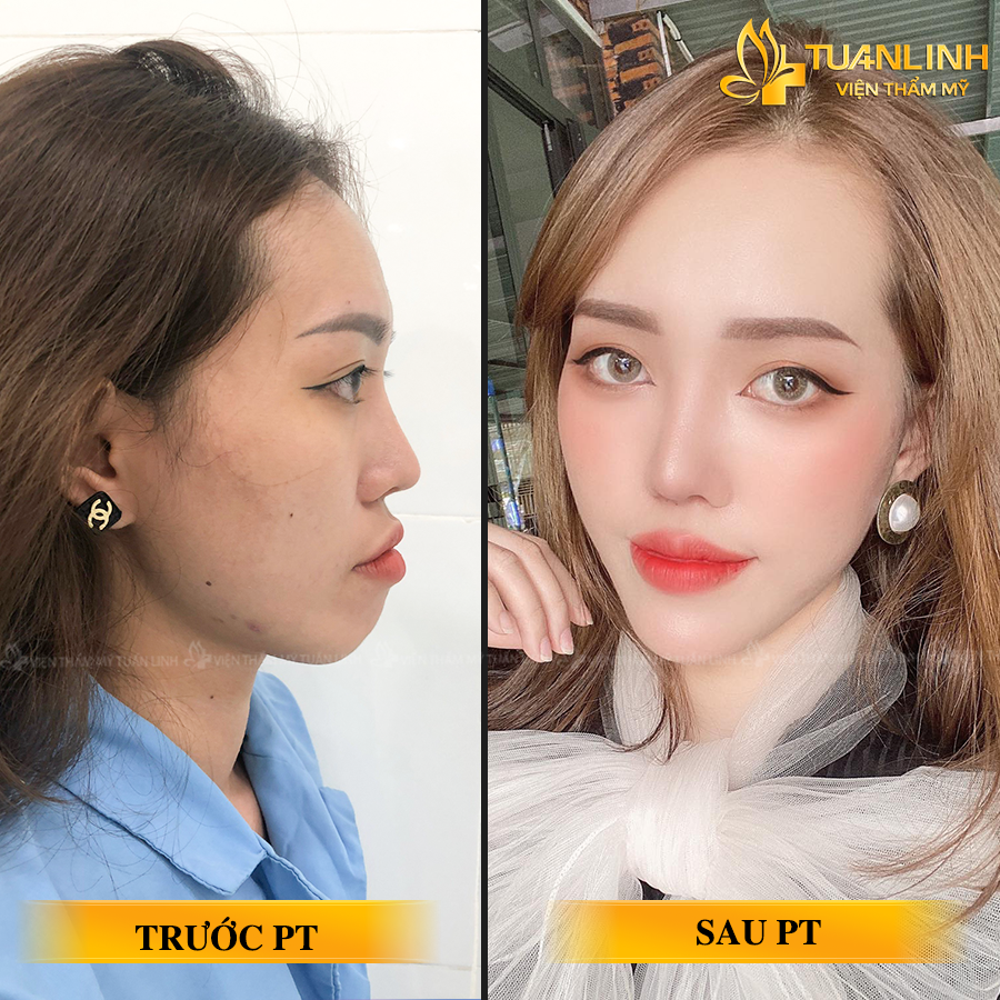 Kết quả độn cằm tại Tuấn Linh | Nên độn cằm hay tiêm filler | Có nên độn cằm không?