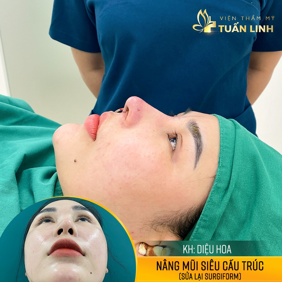 Khách hàng nâng mũi Siêu cấu trúc Surgiform