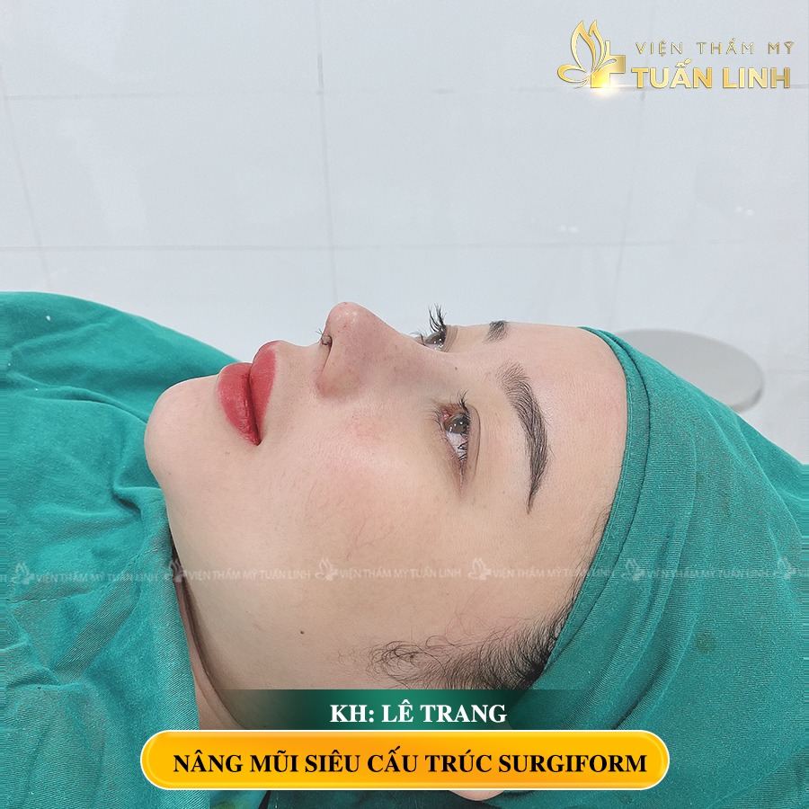Khách hàng nâng mũi Siêu cấu trúc Surgiform
