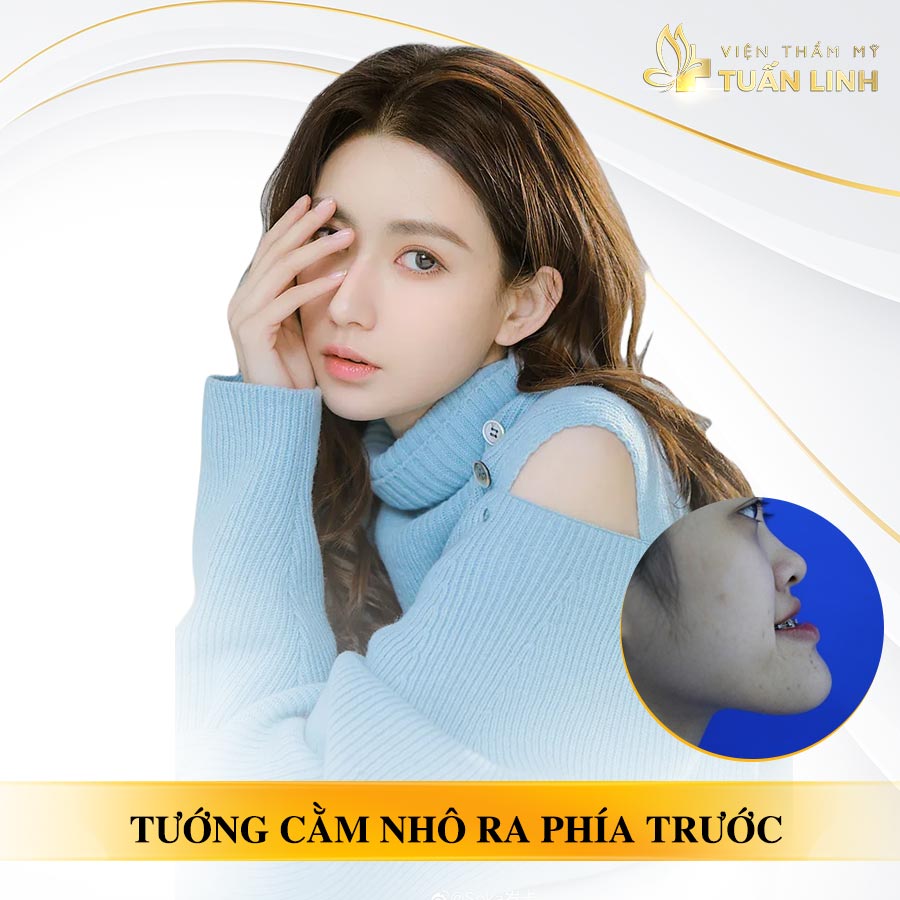 Xem tướng cằm nhô ra trước | Cằm nhô ra phía trước là gì | Xem tướng cằm nhô ra cho nam và nữ