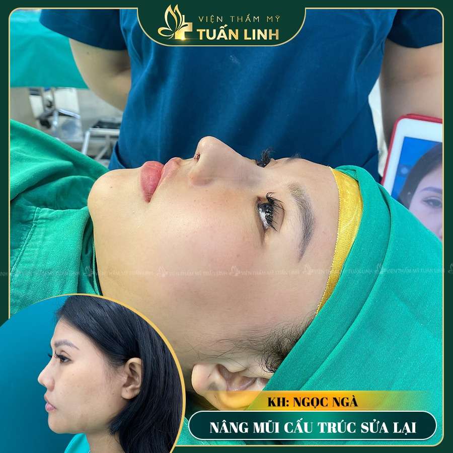 nang mui cau truc sua lai 3