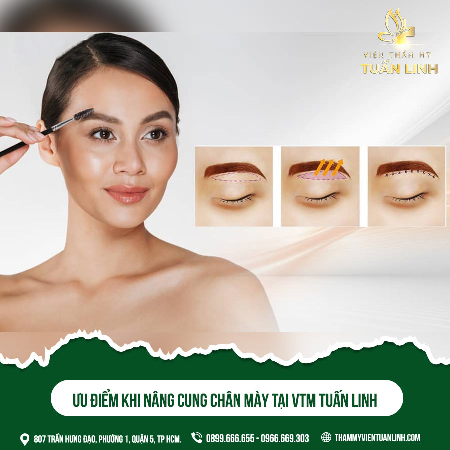 Ưu điểm khi nâng cung chân mày tại VTM Tuấn Linh | Bạn hỏi - Bác sĩ trả lời: Nâng cung chân mày 1 bên có được không?