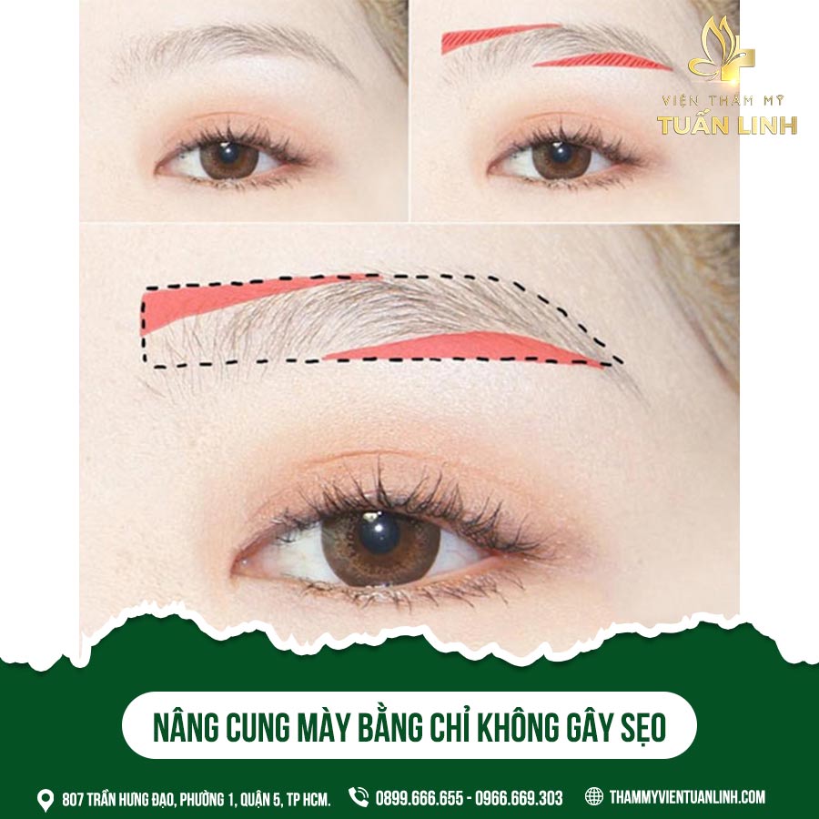 Nâng cung mày bằng chỉ không gây sẹo 