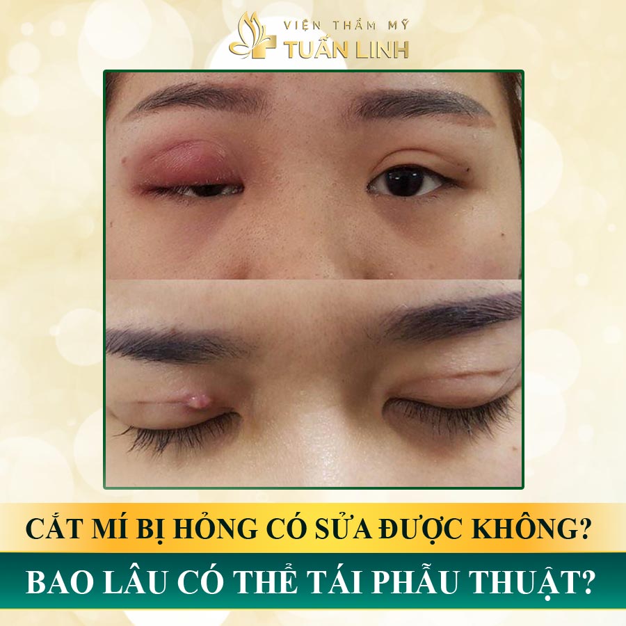 Cắt mí bị hỏng có sửa được không? Bao lâu thì có thể tái phẫu thuật?