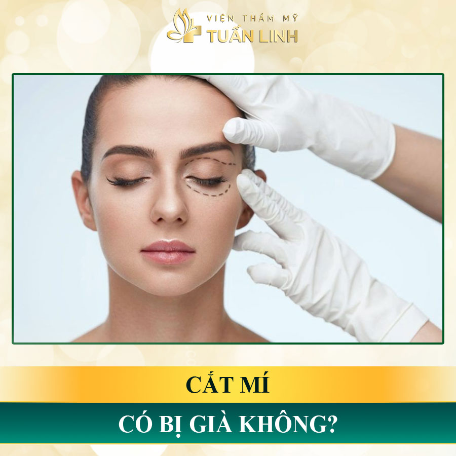 Cắt mí có bị già không | Cắt mí bị già: Nỗi lo của nhiều chị em