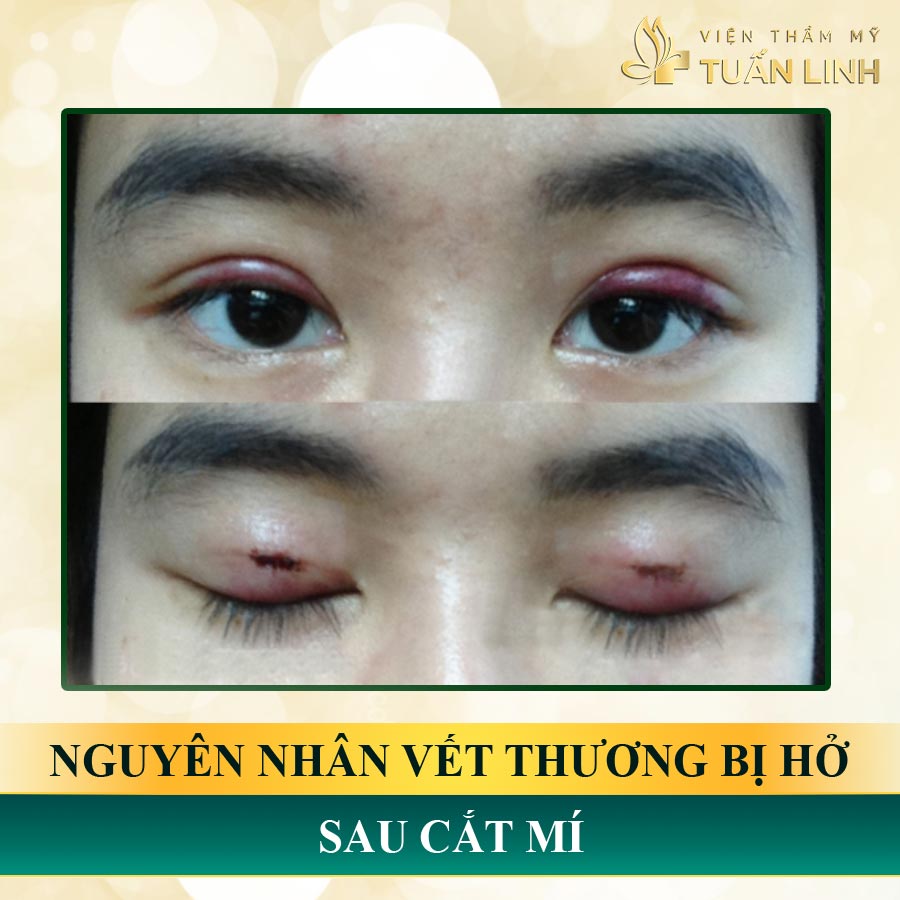 Nguyên nhân vết thương bị hở sau cắt mí | Vết cắt mí bị hở: Dấu hiệu nhận biết và cách xử lý