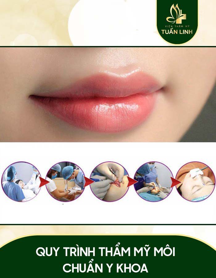 Các bước phẫu thuật môi trề | Phẫu thuật cắt môi trề và 1001 câu hỏi liên quan