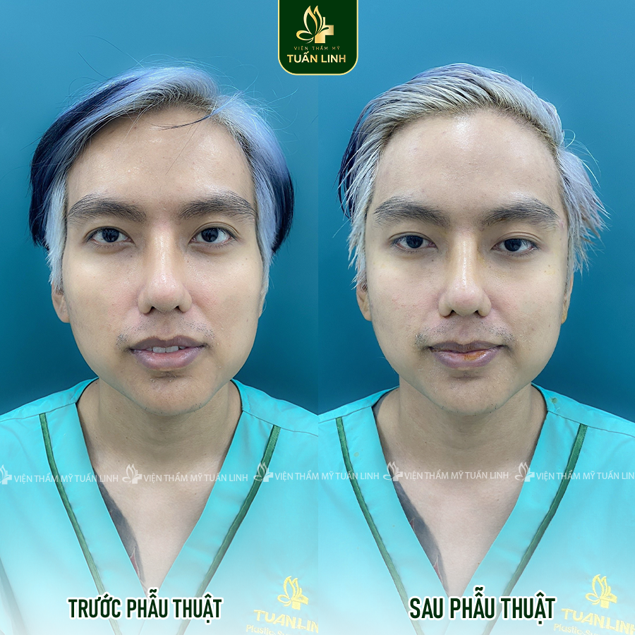Hình ảnh trước và sau khi độn thái dương tại Tuấn Linh