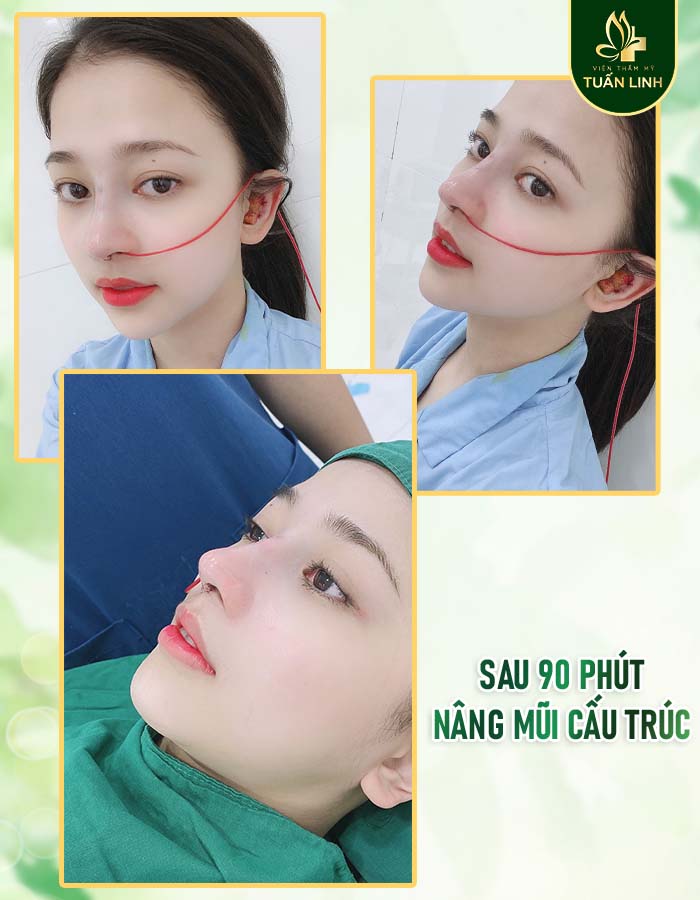 Kết quả sau 90 phút phẫu thuật nâng mũi cấu trúc của Thanh Xuân 