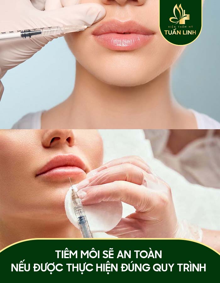 Tiêm môi sẽ an toàn nếu được thực hiện đúng quy trình