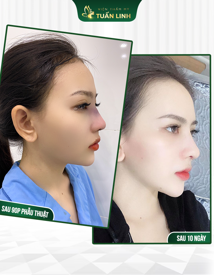 T.H cực kỳ hài lòng với dáng mũi sau phẫu thuật