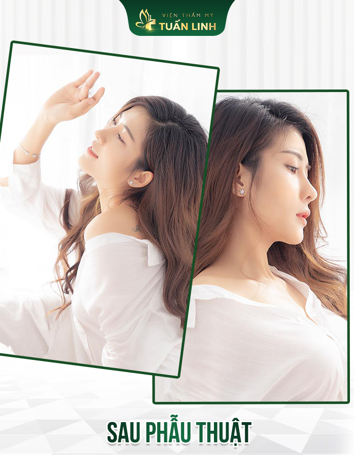 Dáng mũi sau 1 năm sửa lại của cô ấy