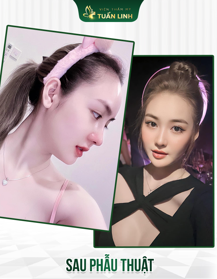 Nâng mũi cấu trúc sẽ giúp dáng mũi bền đẹp dài lâu