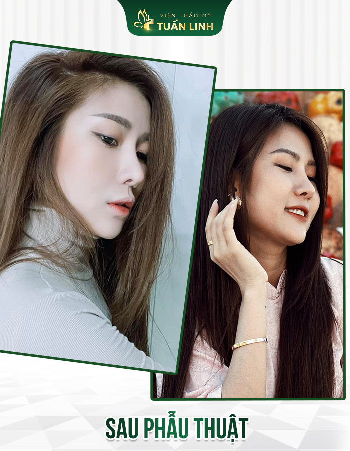 Dáng mũi sau 3 năm sửa lại của cô ấy