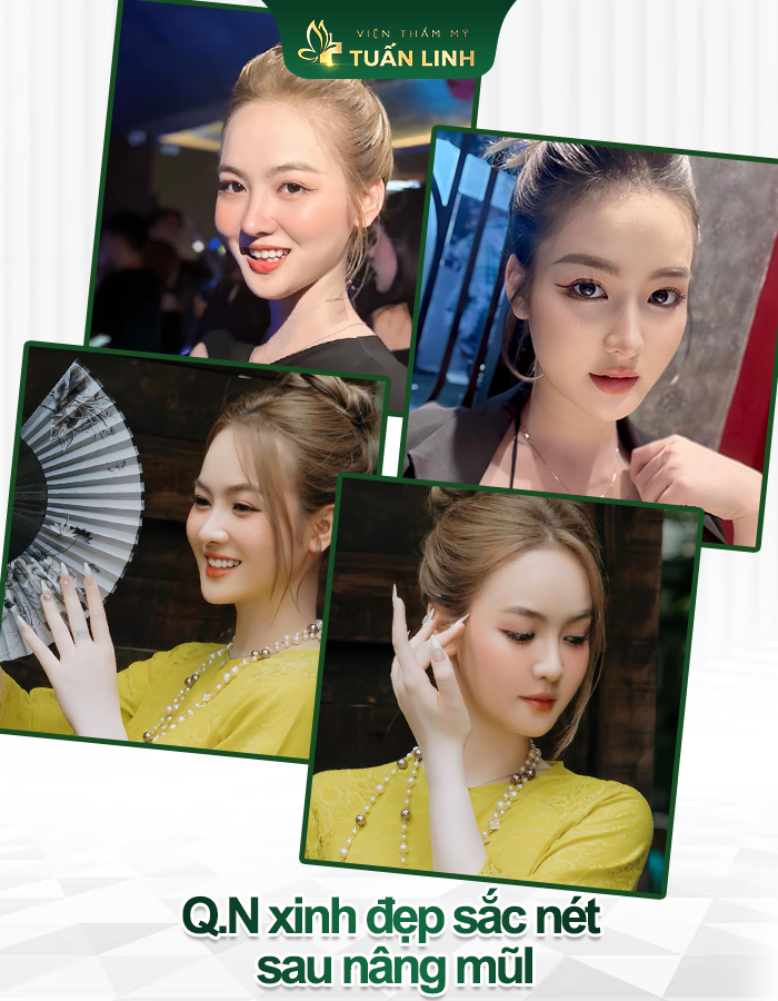 QN xinh đẹp sau nâng mũi