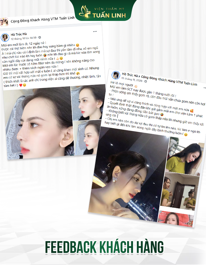 feedback của T.H sau khi nâng mũi