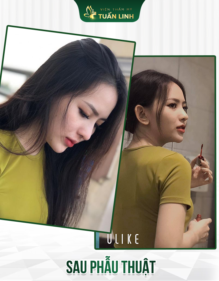 Dáng mũi sau hơn 1 tháng của cô ấy