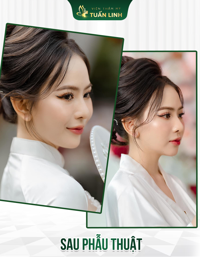 Dáng mũi sau 3 năm cực kỳ tự nhiên và không hề bị xuống cấp