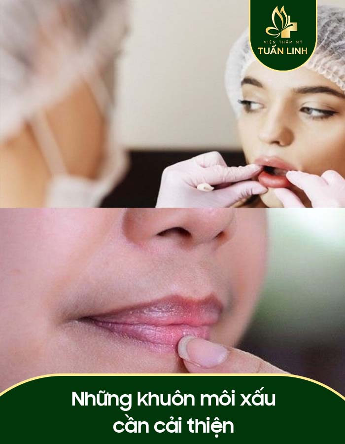 Những khuôn môi xấu cần cải thiện