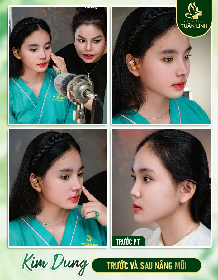 Khách hàng Kim Dung trước và sau nâng mũi