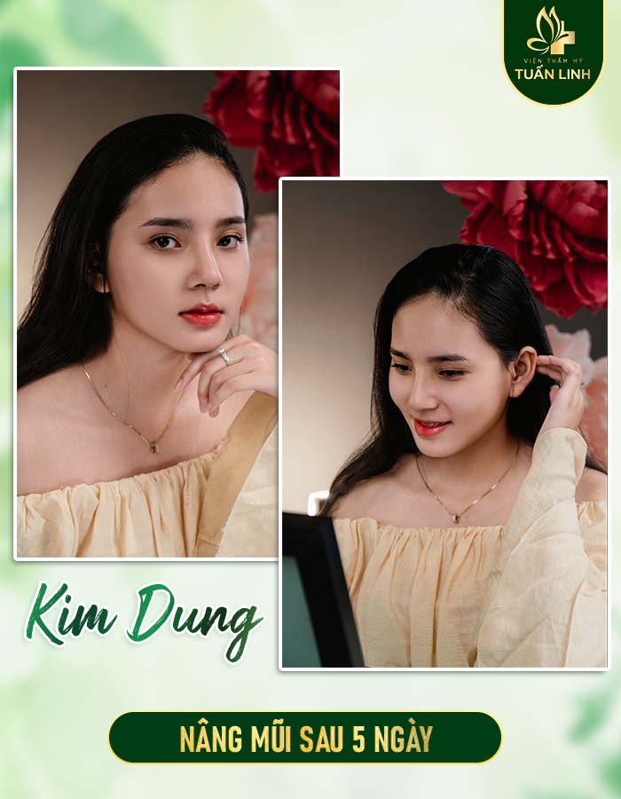 Khách hàng Kim Dung sau 5 ngày nâng mũi