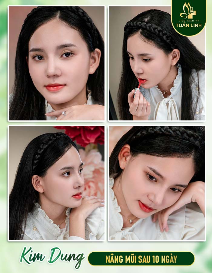 Khách hàng Kim Dung sau 10 ngày nâng mũi
