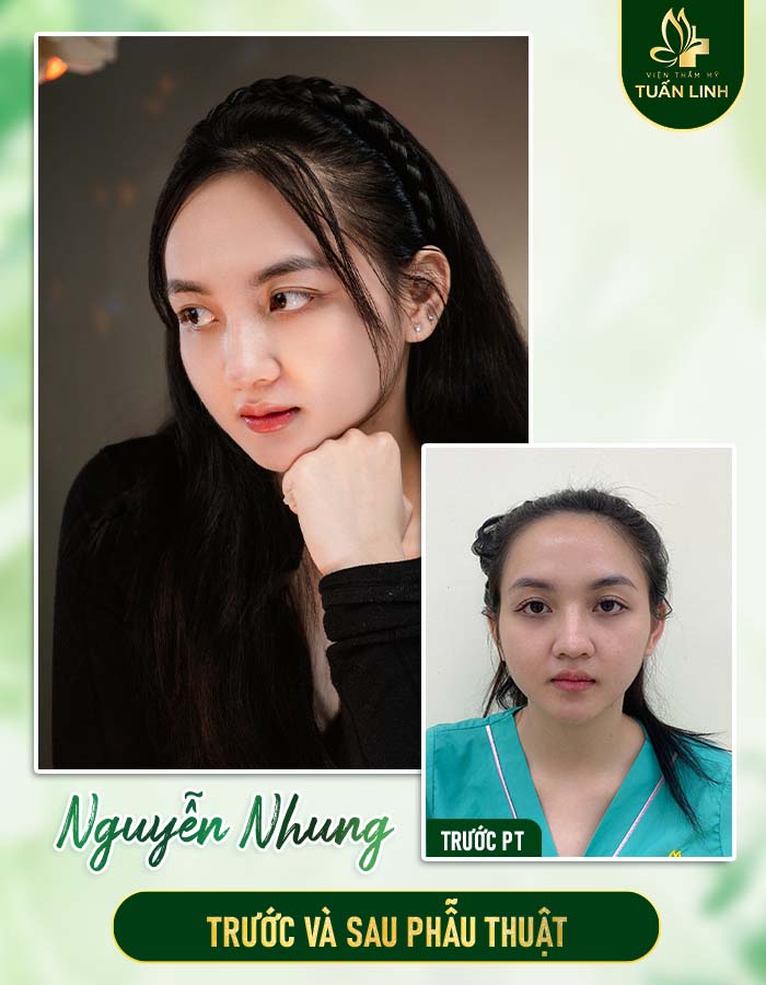 Khách hàng Ngọc Nhung trước và sau nâng mũi
