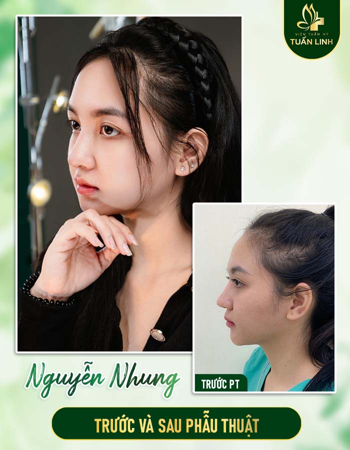 Khách hàng Ngọc Nhung trước và sau nâng mũi
