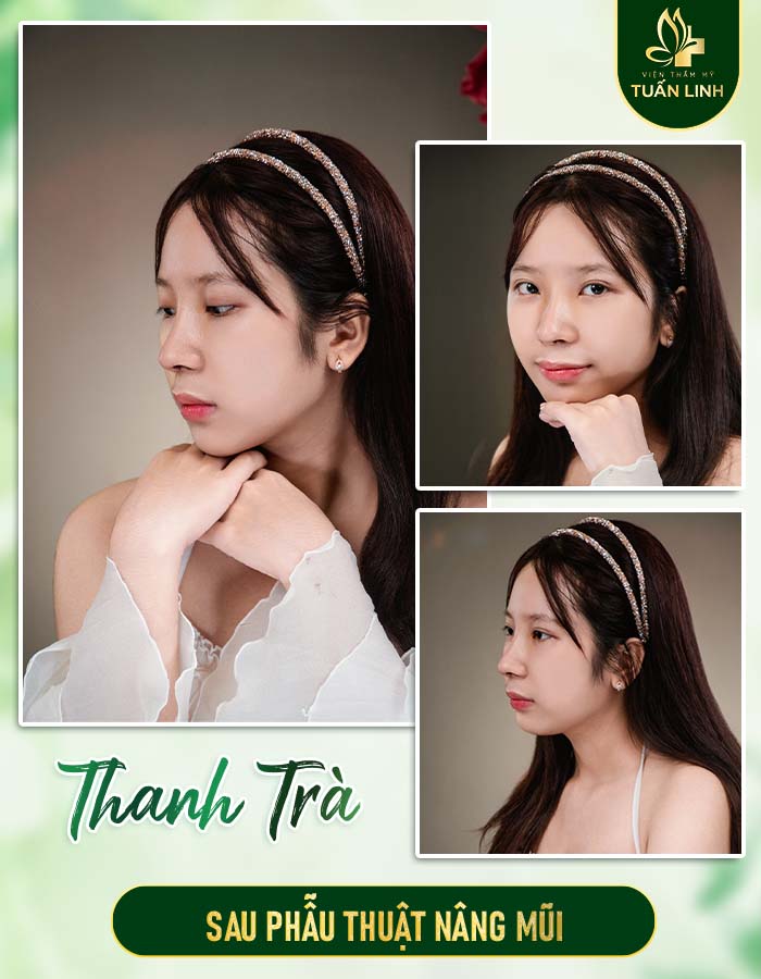 Khách hàng Thanh Trà sau nâng mũi