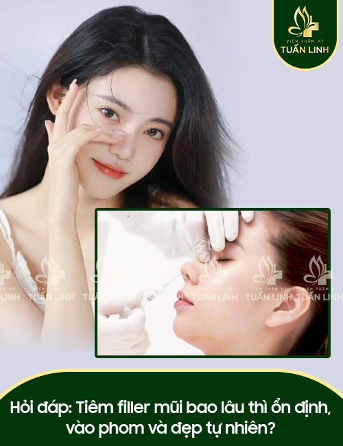 Hỏi đáp: Tiêm filler mũi bao lâu thì ổn định, vào phom và đẹp tự nhiên?