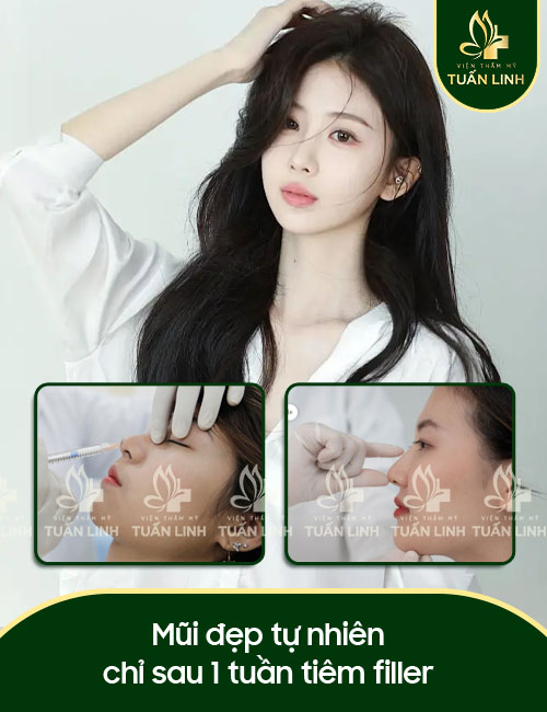 Mũi đẹp tự nhiên chỉ sau 1 tuần tiêm filler
